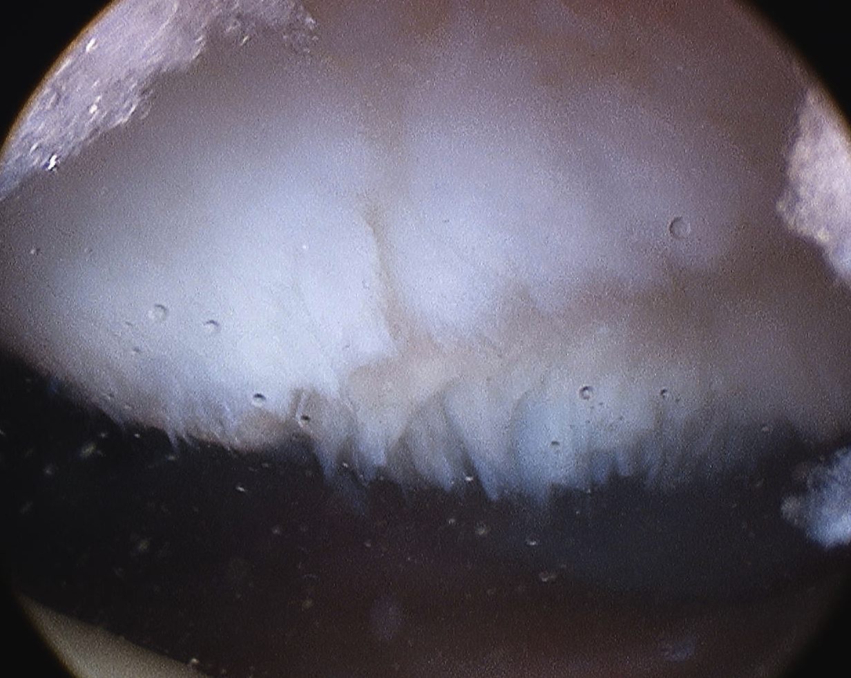 Patella Grade 3 Arthroscopy